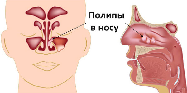 Полипы полости носа